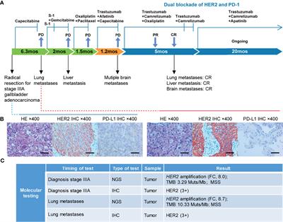 Case Report: Addition of PD-1 Antibody Camrelizumab Overcame Resistance to Trastuzumab Plus Chemotherapy in a HER2-Positive, Metastatic Gallbladder Cancer Patient